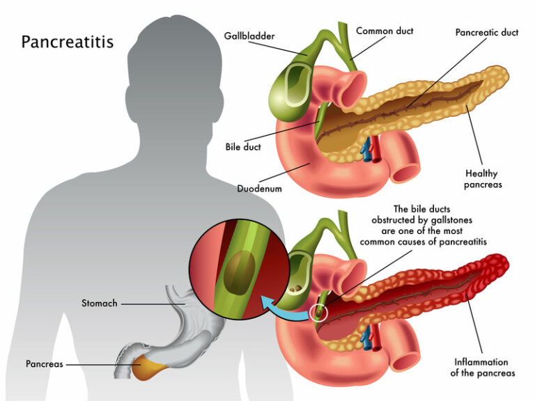 pancreatic-diseases-dr-aniruddha-bhosale